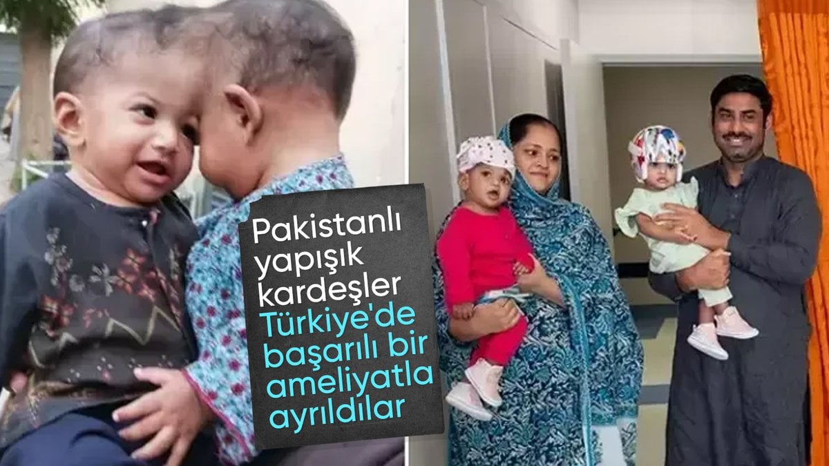 Türkiye’ye getirilen Pakistanlı yapışık ikizler 14 saatlik operasyonla ayrıldı